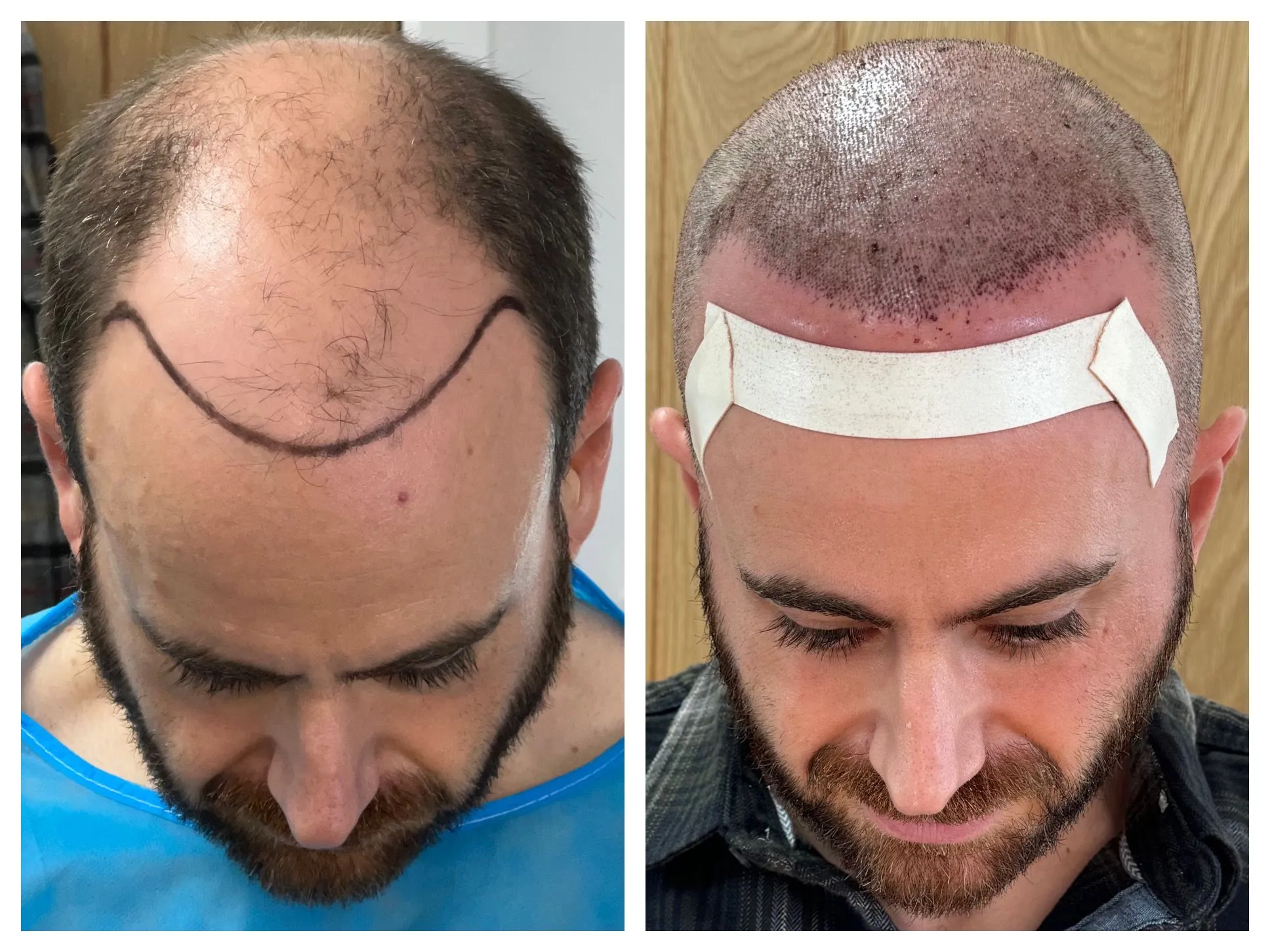 New York’s Trusted Hair Replacement Studio
